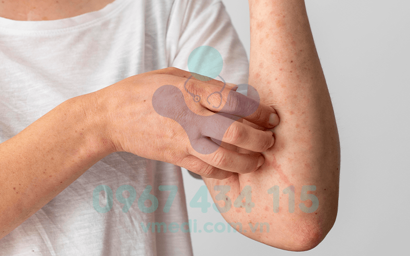 Sốc phản vệ do cơ thể phản ứng lại với các chất dị nguyên