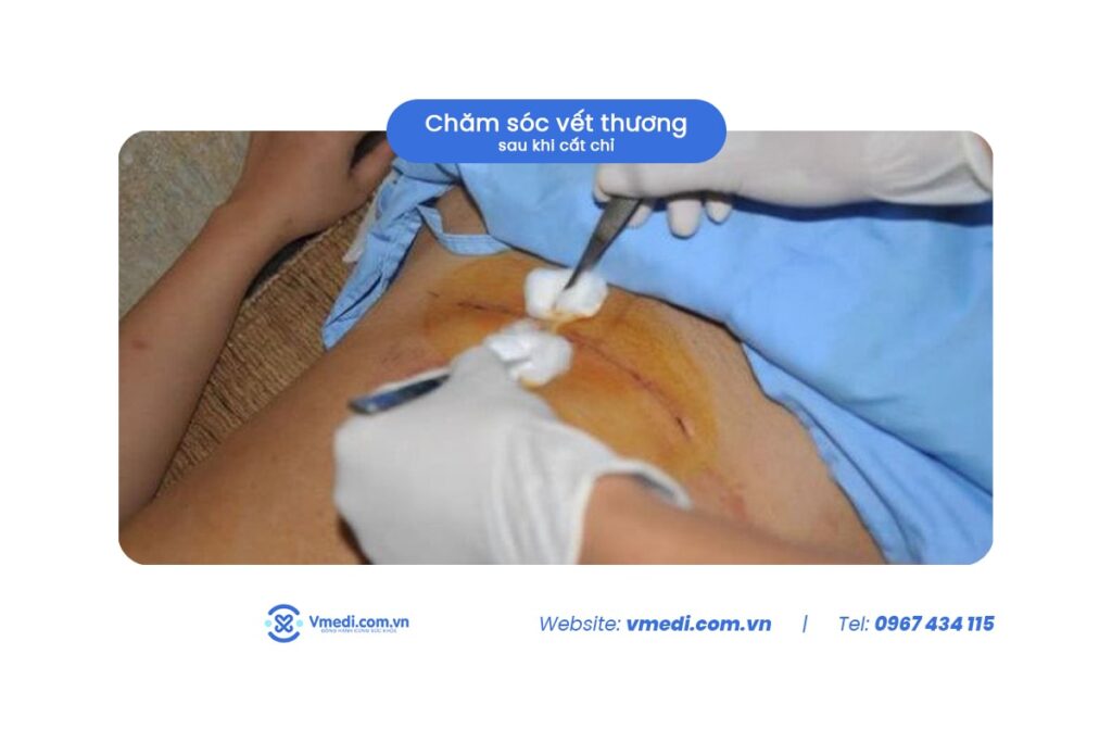 cham-soc-vet-thuong-sau-khi-cat-chi